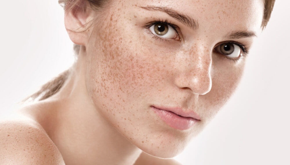home remedies for hyperpigmentation face