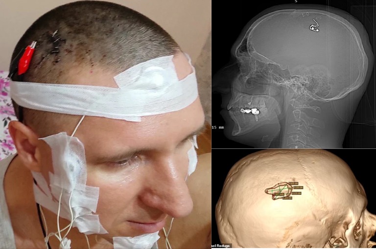 Russian Man Drills His Skull To Insert 'Dream Controlling' Chip In Brain