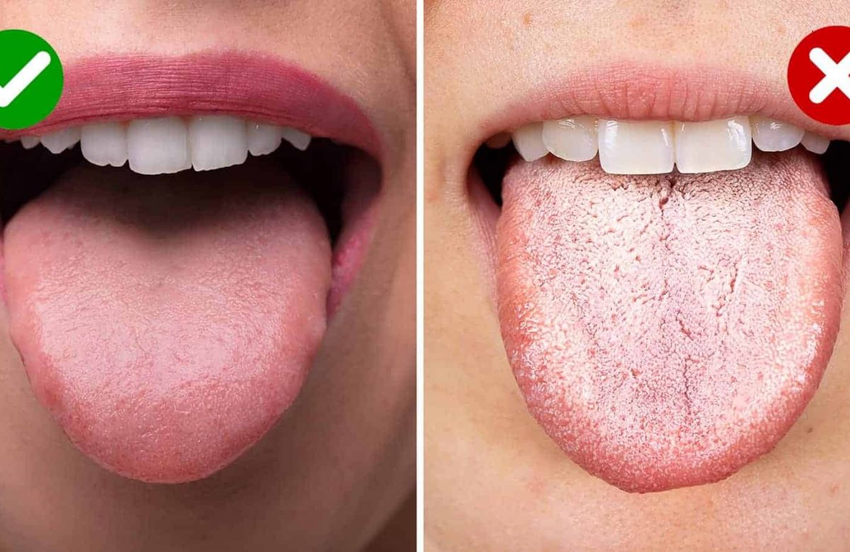 Home remedies to get rid of white tongue