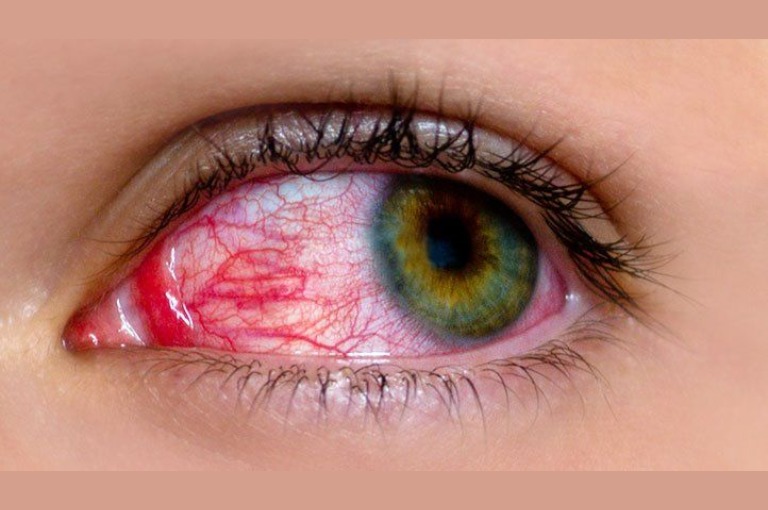 In a single week, 40,477 people in the state were infected with 'Madras Eye'