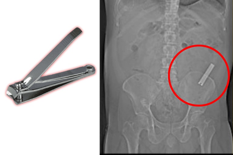 Man who had swallowed a nail cutter 8 years ago and was admitted to the hospital with stomach pain