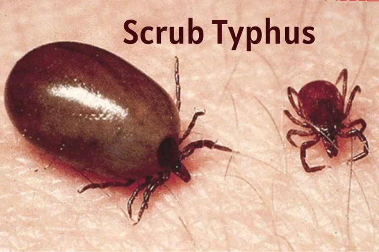 Odisha On High Alert As Scrub Typhus Claims Six Lives. Details